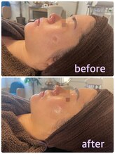 サニー(SUNNY)/フォト小顔フェイシャルコース