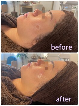 サニー(SUNNY)/フォト小顔フェイシャルコース