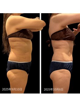 クールヴィラ(Cool Villa)/腹部冷却6カップ4回+電磁パルス