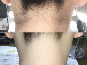 カルム(Calme)/うなじ脱毛