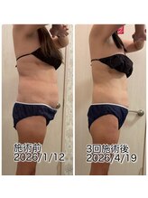 クールスパ(COOL SPA)/40代女性 お腹症例