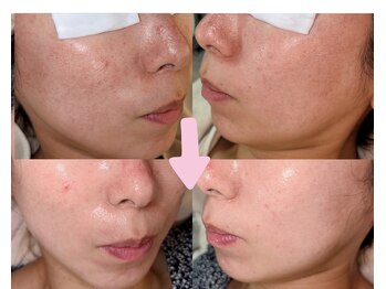 ルイーズ(Louise)の写真/【トラブル・悩み肌ケア×専門知識】個々が持つお肌トラブルに合わせた本格ケアを提案◎