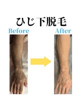 ヒゲマスター 三島店/ひじ下脱毛