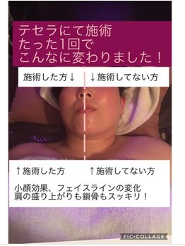 テセラ(TETHERA)/ラジオ波を駆使したテクニック♪