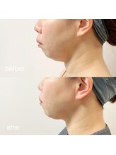 デディア 恵比寿(dedia)/脂肪分解小顔施術/レモンボトル