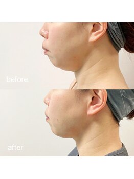 デディア 恵比寿(dedia)/脂肪分解小顔施術/レモンボトル