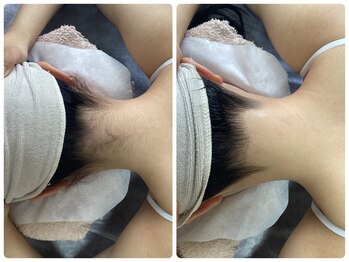 ルルトウキョウ 池袋店(LULU.tokyo)/うなじ脱毛