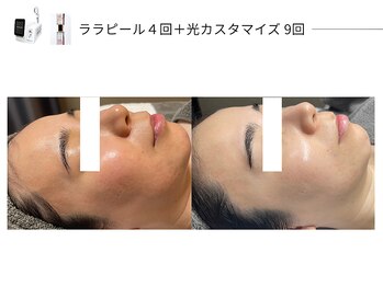 スパレーカ(Spa laka)/光カスタマイズ＋ララピール