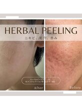 ココ(KOKO)/ハーブピーリングBeforeAfter