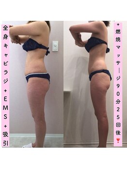 エスポワール(Espoir)/痩身キャビラジ+EMS+吸引25回後
