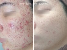 アート ビューティールーム(art beauty room)/美肌計画 毛穴・角質・角栓ケア