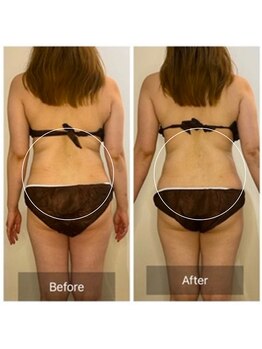 ウィズ ユー ビューティ(with U beauty)/背中の肉もスッキリ