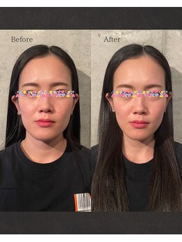 ハリトト鍼灸院/美容鍼灸 施術例 20代女性