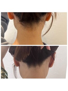 ミース 北九州店/脱毛1回目から驚くほどスッキリ!