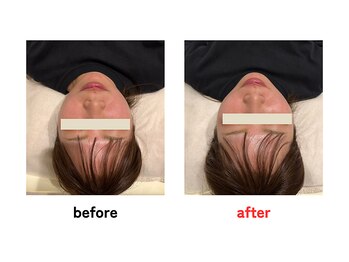 四条大宮アシスト鍼灸整骨院/美容鍼ビフォーアフター