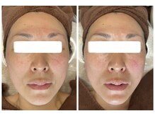 トイボーテ(toi beaute)/高濃度ヒト幹細胞培養液97%