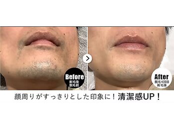RBL 梅田店/メンズ脱毛/ヒゲ脱毛4回目剃毛後