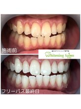 ホワイトニングサロン 札幌店/【ホワイトニング】#札幌#大通り