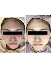 ザ フェース 京都御池店(THE FAITH)/お客様の肌変化