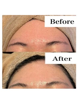 ライム 天神(LIME)/おでこのシワ改善、毛穴ケアに