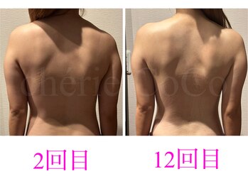 シェリーココ(cherie CoCo)/背中、二の腕、ウエストの変化