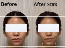 ベール(BEHL)/コルギのBeforeと4回施術後