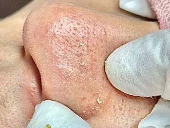 エミュ(emu)の写真/【毛穴特化の結果重視肌質改善】長年の毛穴悩みは［毛穴エクストラクションプロ］にお任せください！