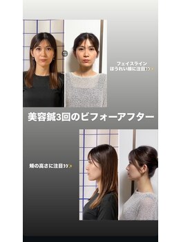 あらかき接骨院/【美容鍼】