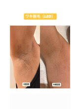 サロンエヌ 久留米店(Salon N)/ワキ脱毛before/after