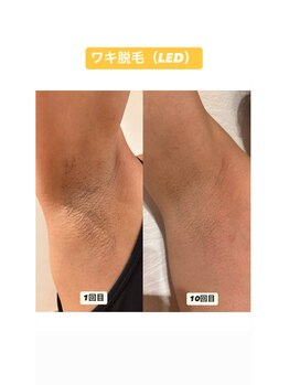 サロンエヌ 久留米店(Salon N)/ワキ脱毛before/after