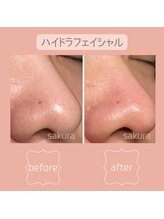 ビューティートータルサロン サクラ 千歳店(SAKURA)/毛穴洗浄☆ハイドロフェイシャル