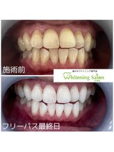 ホワイトニングサロン 札幌店/【ホワイトニング】#札幌#大通り