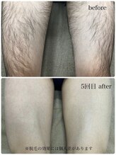 コモレビ(comorebi)/足脱毛（経過画像）