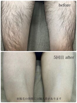 コモレビ(comorebi)/足脱毛（経過画像）