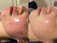 リリアス(RILLIAS)の雰囲気（ニキビケア/赤みケア/毛穴ケア/凹凸ケア）