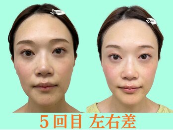 ナチュラルパーフェクトフェイス 新宿/5回目・左右差整う/新宿小顔矯正