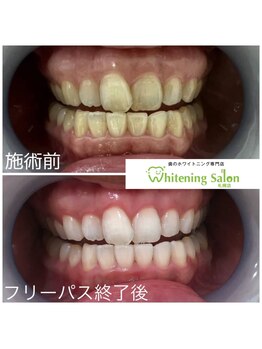 ホワイトニングサロン 札幌店/【ホワイトニング】#札幌#大通り