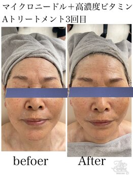 リッチベル(richbelle)/人気NO1メニュー