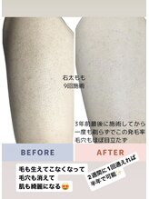 エピラージュ 町田店/全身脱毛