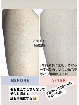 エピラージュ 町田店/全身脱毛