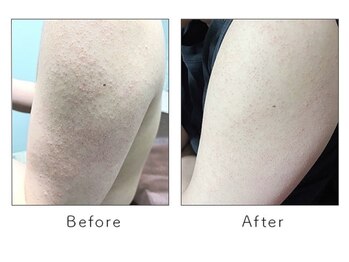 マリーローランメンズグレース(Marryrolan MensGrace)/リベルハーブピーリング症例