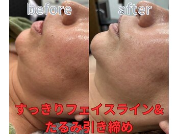 グロワール(gloire)/再生美容(ビフォーアフター)