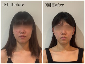 テンディ(TenD.)/【小顔矯正】