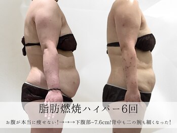 ミヨンラボ(miyon LABO)/脂肪燃焼ハイパー6回