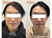 ビーキュート 姫路店(BE-CUTE)/小顔コルギ５回目