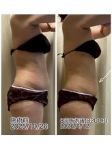 クールスパ(COOL SPA)/お腹症例