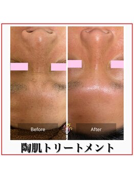 ラナン パラフューズ(Ranun's PARAFUSE.)/陶肌ビフォーアフター(5)