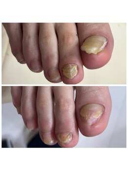 肥厚爪ケア