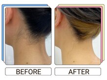 ストラッシュ 三宮店/施術例：うなじ