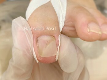 ポジ(Posi.L)の写真/深爪、巻き爪、変形爪等のトラブルネイルを解決！様々な爪の症状でお悩みの方はぜひ一度お越しください！